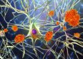 The FDA approved a new drug to treat Alzheimer’s, but Medicare won’t always pay for it – a doctor explains what researchers know about Biogen’s Aduhelm