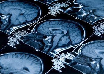 In Alzheimer’s, DNA errors stress cells, create dysfunction