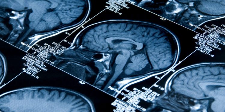 In Alzheimer’s, DNA errors stress cells, create dysfunction