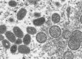 UN agency denounces ‘homophobic and racist stereotypes’ in monkeypox reporting