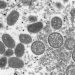 What we know about monkeypox cases in the US