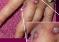 Here are the signs and symptoms of monkeypox