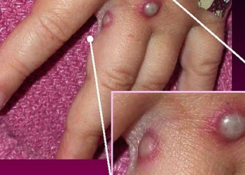 UK recommends people who test positive for monkeypox abstain from sex