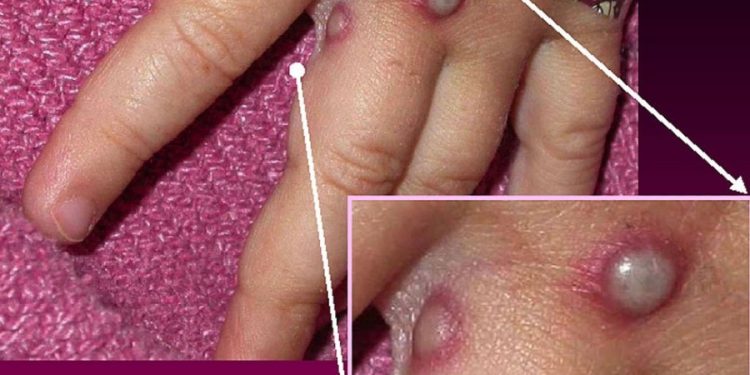 UK recommends people who test positive for monkeypox abstain from sex