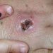 Chicago, Philadelphia, LA County record first monkeypox cases