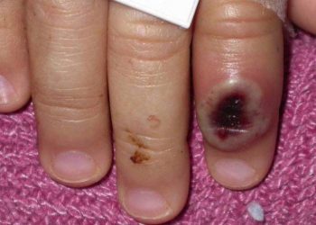 Here are the states with monkeypox cases