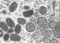 Feds buy 500,000 more vaccine doses to fight monkeypox