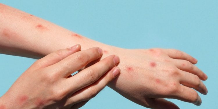 Who should get the monkeypox vaccine?