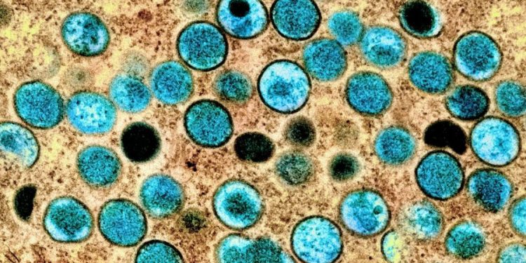 Black and Hispanic people bearing brunt of monkeypox cases: analysis