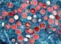 Most patients hospitalized for monkeypox were HIV-positive in CDC report
