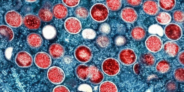 Most patients hospitalized for monkeypox were HIV-positive in CDC report