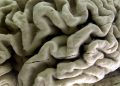 FDA approves new Alzheimer’s drug that moderately slows disease