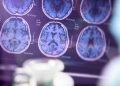 Government to launch $300M Alzheimer’s research database