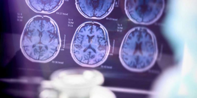 Government to launch $300M Alzheimer’s research database