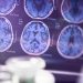 Eli Lilly Alzheimer’s treatment slows cognitive decline in trial, company says