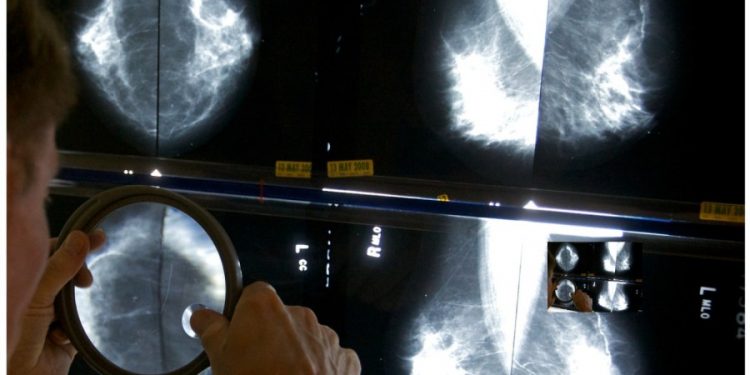 Breast cancer screening: What you need to know, at any age 
