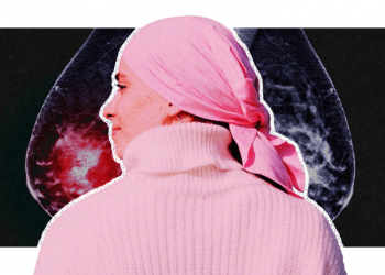 Breast cancer rates are rising. But more women are surviving too 