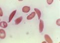 FDA approves first use of CRISPR gene editing to treat sickle cell disease