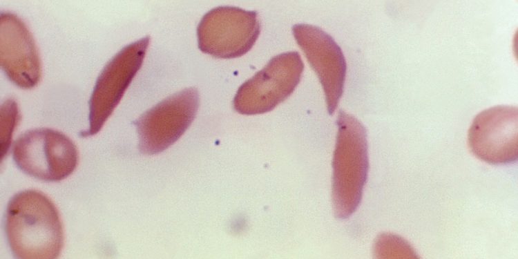 FDA approves first use of CRISPR gene editing to treat sickle cell disease