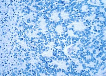 FDA to require new warning of secondary cancer risk for CAR T cancer therapies