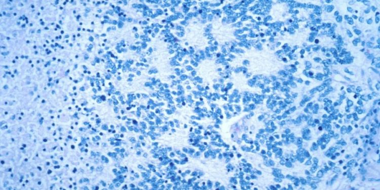 FDA to require new warning of secondary cancer risk for CAR T cancer therapies