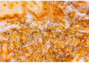 US sees record syphilis cases as funding cuts threaten to worsen epidemic