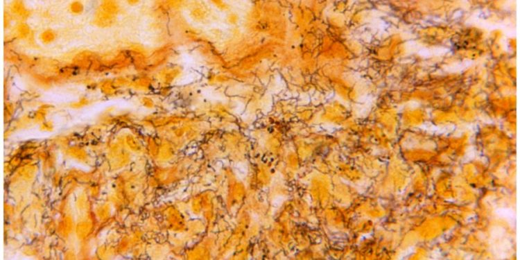 US sees record syphilis cases as funding cuts threaten to worsen epidemic