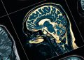 FDA approves Lilly’s new Alzheimer’s drug after delay