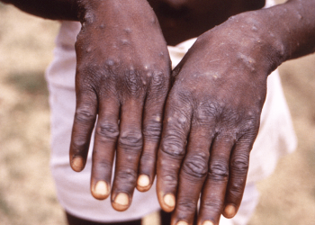 Faster spreading strain of mpox raises alarm in Congo