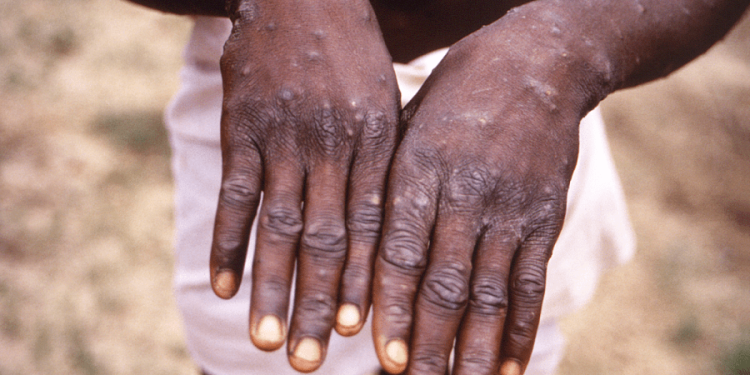 Faster spreading strain of mpox raises alarm in Congo