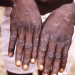 Faster spreading strain of mpox raises alarm in Congo