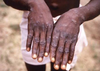 CDC warns of more severe mpox strain spreading in Central Africa