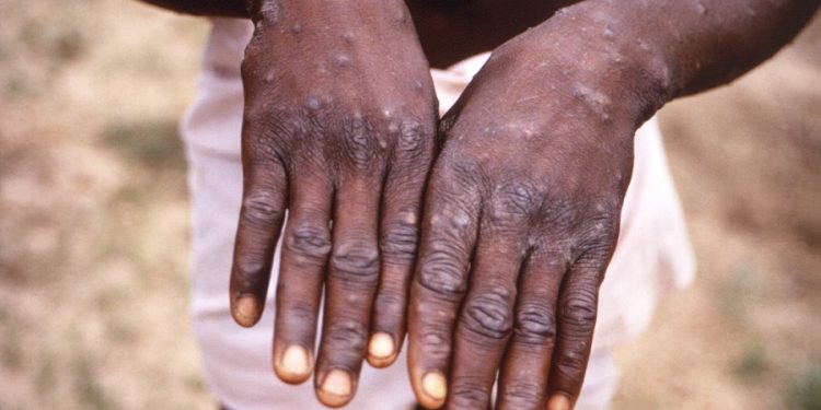 CDC warns of more severe mpox strain spreading in Central Africa