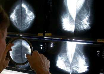 Breast cancer diagnoses ticking up among young women, Asian Americans: Research