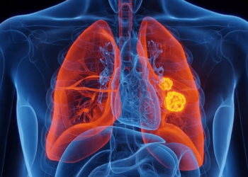 Lung cancer survival rate improves: Research