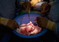 Surgeons implant new kind of engineered pig kidney