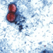 Doctor warns against ‘cyclospora skinny’ trend
