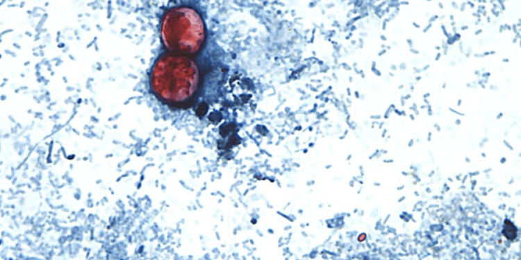 Cyclospora cases mounting in Michigan