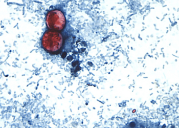 Cyclospora cases in US hit all time high
