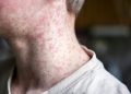 US exceeds measles cases in all of 2025 by July of 2026