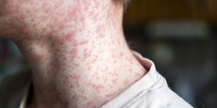 US exceeds measles cases in all of 2025 by July of 2026