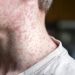 US exceeds measles cases in all of 2025 by July of 2026