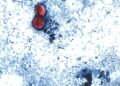 Why cyclospora can be deadly for some people