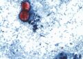 More than 20K cyclosporiasis cases suspected in US as outbreak reportedly linked to 6 more states