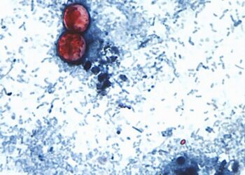 More than 20K cyclosporiasis cases suspected in US as outbreak reportedly linked to 6 more states