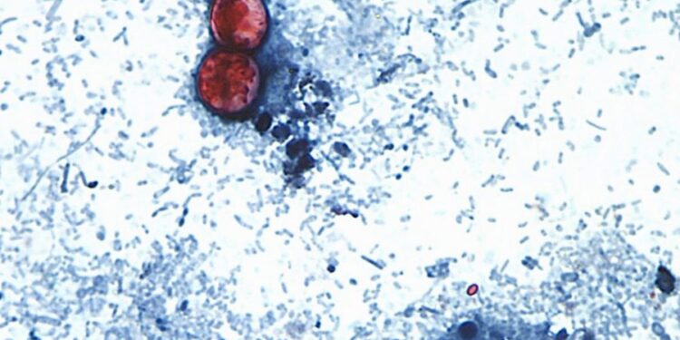 More than 20K cyclosporiasis cases suspected in US as outbreak reportedly linked to 6 more states