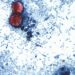 More than 20K cyclosporiasis cases suspected in US as outbreak reportedly linked to 6 more states