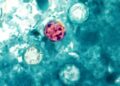 Yet another cyclosporiasis outbreak appears as cases linked to recalled lettuce grow