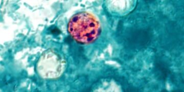 Yet another cyclosporiasis outbreak appears as cases linked to recalled lettuce grow