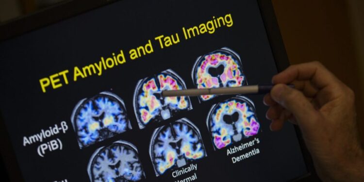 Naturally occurring human peptide shows promise against Alzheimer’s